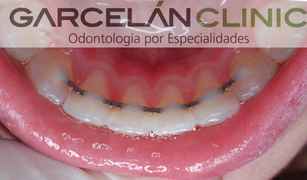 retenci%C3%B3n-en-ortodoncia.png
