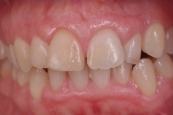 boca sana, periodoncia en sevilla, sangrado de encías, infección de encías, solución a la periodontitis