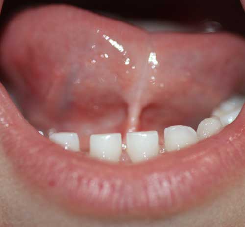 eliminación del frenillo del boca en sevilla