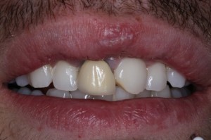 prótesis dental en sevilla