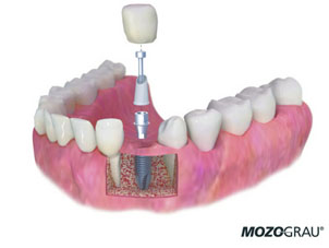 implantes dentales en sevilla, implante dental sevilla