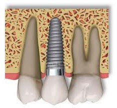 esquema de implante dental, implantes dentales sevilla