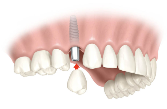 implante dental en sevilla, implantes dentales en sevilla, precio implante dental