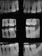 radiografía para saber el estado de salud de las encías, periodoncia en sevilla