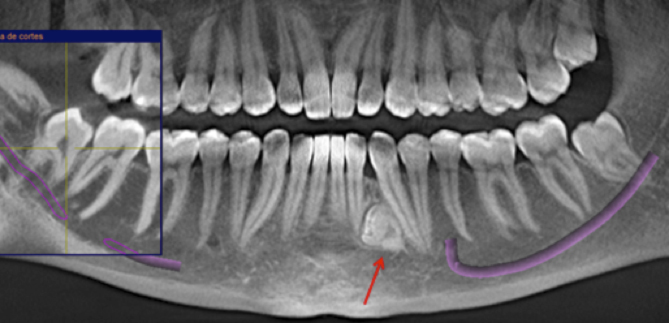 Imagen de Radiografía 3D realizado a la paciente para poder determinar la situación del diente supernumerario en las 3 dimensiones del espacio.