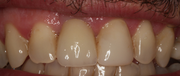 boca con corona sobre implante, después de de tratamiento de reposición de dientes, carillas de composite en sevilla