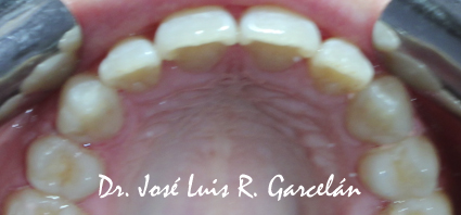 foto de intraoral con dientes alineados