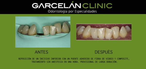 protesis dental sevilla, dentista sevilla