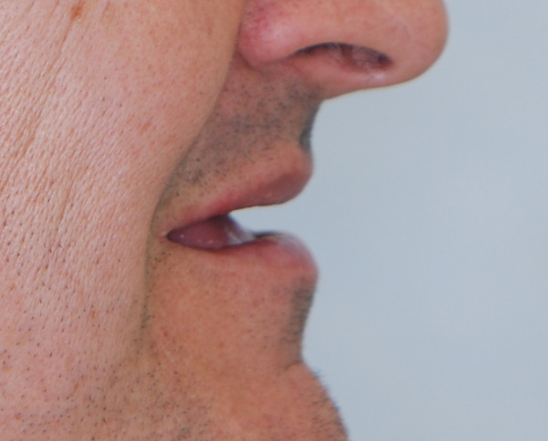 Boca de paciente desdentado antes de su tratamiento de prótesis dental