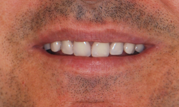 boca de paciente con sobredentadura, tras tratamiento de prótesis dental