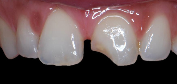 dentadura tras carilla de composite