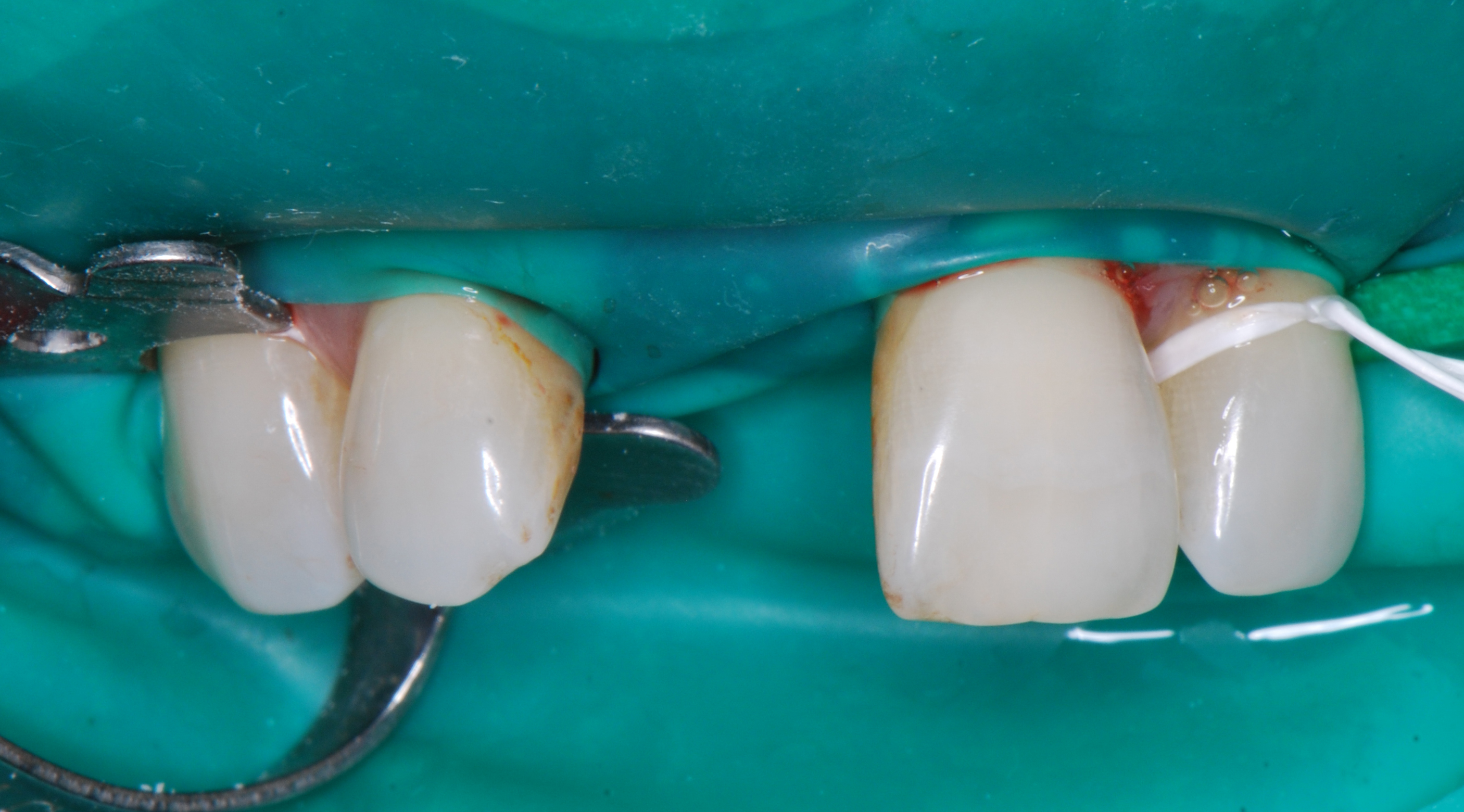  el mismo día de la extracción del incisivo, sale de la consulta con su diente fijo y el implante puesto.