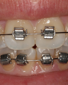 ortodoncia en sevilla, brackets metálicos en sevilla