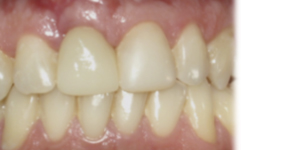después de tratamiento de reposición de dientes, carillas de composite en sevilla