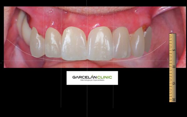diseño digital de sonrisa sevilla, dentista sevilla, clinica dental sevilla