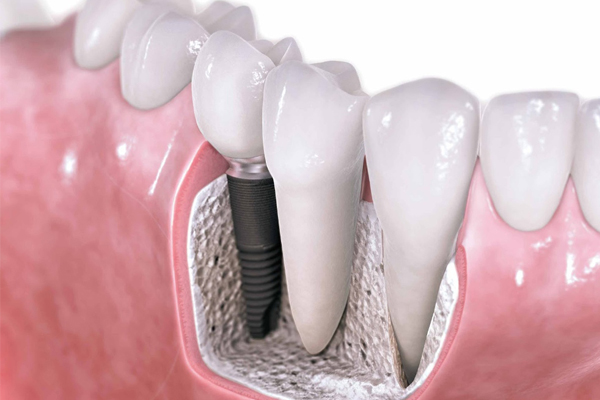 implantes dentales en Sevilla, Implante dental en Sevilla, precio implante dental en Sevilla