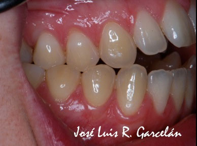 ortodoncia sevilla, mordida abierta, dentista sevilla
