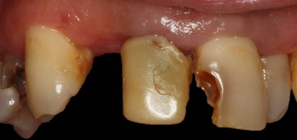 boca antes del tratamiento de puente de circonio-porcelana, prótesis dental en Sevilla