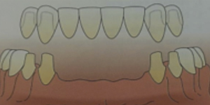prótesis dental sevilla, prótesis dentales en sevilla, prótesis sobre implantes en sevilla