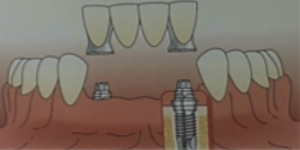 prótesis dental sevilla, prótesis dentales en sevilla, prótesis sobre implantes en sevilla