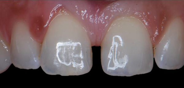 dentadura tras carilla de composite