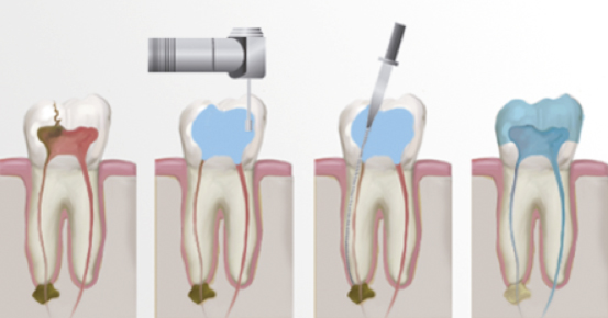 tratamiento de endodoncia