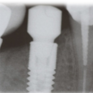 Radiografía de implante dental bien integrado, estudio de colocación de implantes dentales en sevilla, implantes dentales sevilla, implante dental sevilla