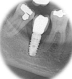 Radiografía de implante dental perdido, estudio de colocación de implantes dentales en sevilla, implantes dentales sevilla, implante dental sevilla