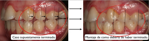 maloclusión, claves para saber si te han hecho un buen estudio de ortodoncia