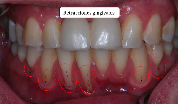 retracciones gingivales, claves para saber si te han hecho un buen estudio de ortodoncia