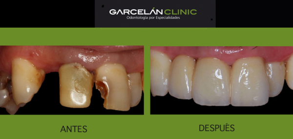 antes y después de tratamiento de protesis fija, como mantener y cuidad tu prótesis fija, prótesis dental en sevilla