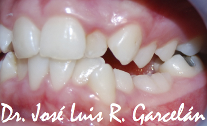caso clínico antes de ortodoncia: retrusión maxilar