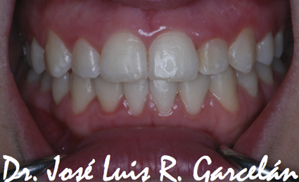 caso clínico después de ortodoncia: retrusión maxilar