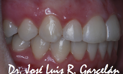 caso clínico después de ortodoncia: retrusión maxilar