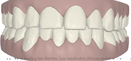 ortodoncia invisible sevilla