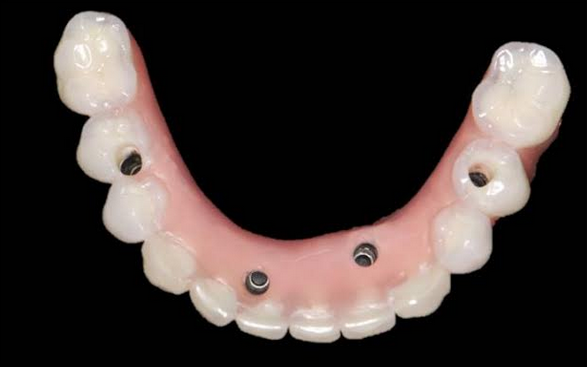 Prótesis híbrida inferior (fija) atornillada a 4 implantes. prótesis dental en sevilla