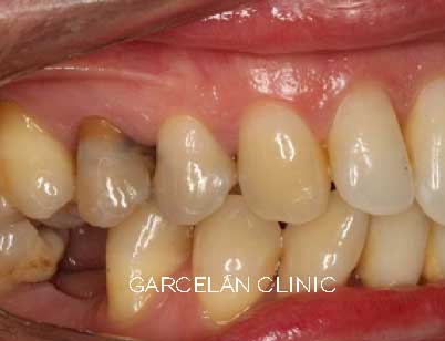 tinción de dientes por amalgama de materiales de endodoncia
