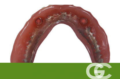 Interior de una Sobredentadura inferior sobre dos implantes, problemas y limtaciones de las dentaduras postizas