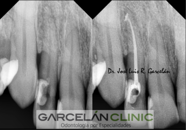 endodoncia realizada correctamente, endodoncia sevilla, dentista sevilla, clinica dental sevilla