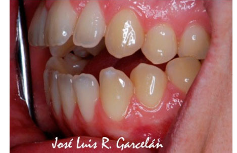 ortodoncia sevilla, mordida abierta, dentista sevilla