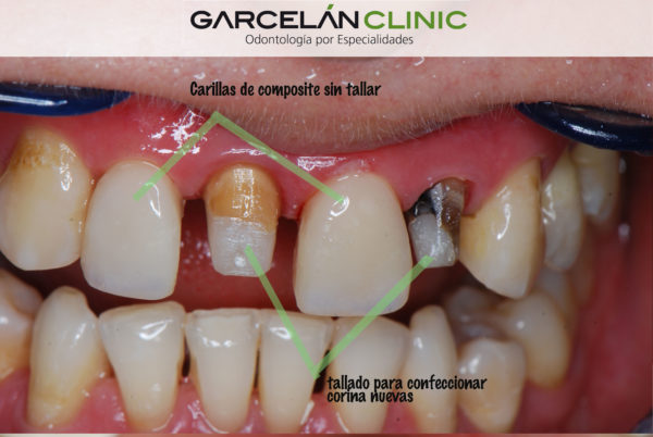 carillas sevilla, coronas sevilla, fundas dentales en sevilla