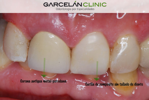 carillas en sevilla, carillas sin tallado de dientes en sevilla