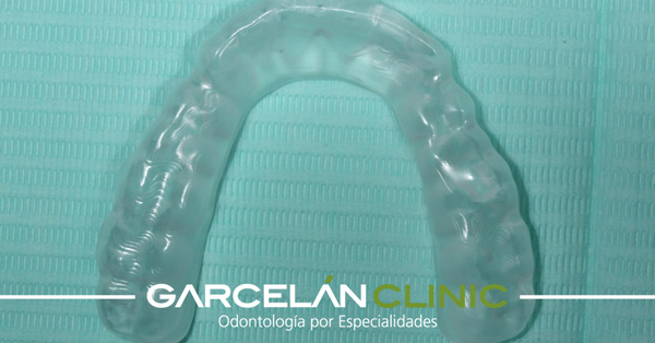 Férula de descarga contra los mareos provocados por contracturas musculares | Dentistas en Sevilla - Clínica Dental Garcelán